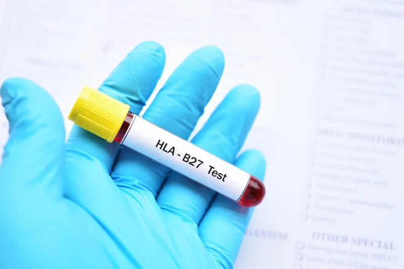 Antigeno HLA B27 1